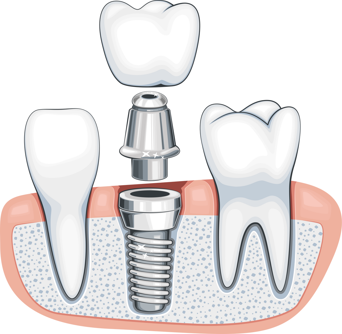 Dentist Illustration, dental implant surgery